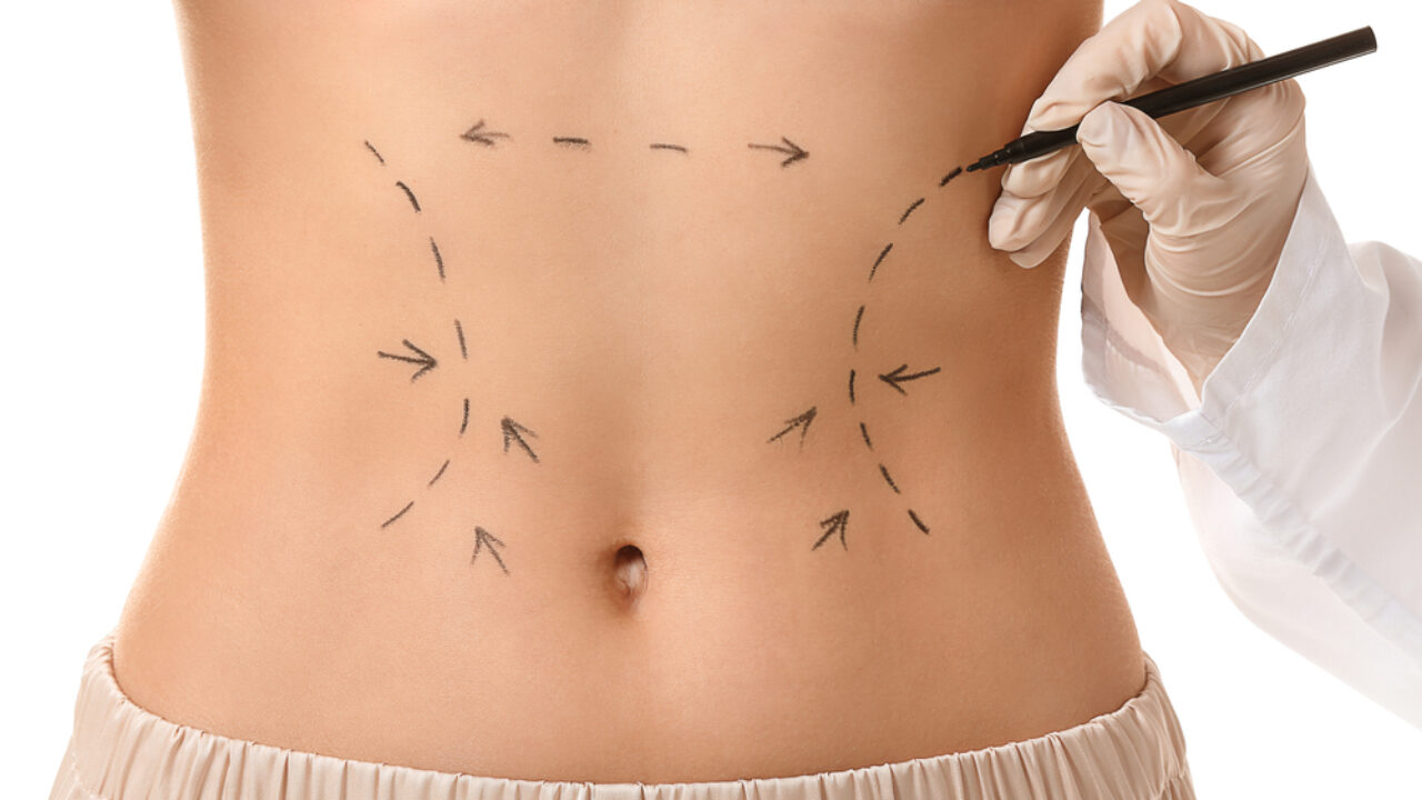 Lipoaspiração