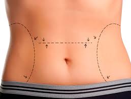 Abdominoplastia
